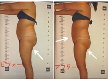 ビューティースパ/お腹-4cm、お尻-4cm
