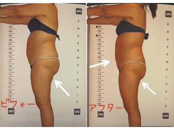 ビューティースパ/お腹-4cm、お尻-4cm