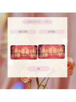 プラスビー 2号店(+b)/ホワイトニングビフォーアフター