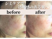 パールホワイトニングサロン 小田原店/シミケアとララピールで艶肌へ