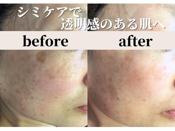 パールホワイトニングサロン 小田原店/シミケアとララピールで艶肌へ
