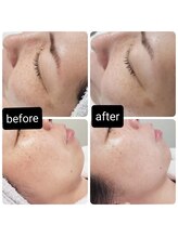 ソラ(sora)/ハイドロ・毛穴の症例★