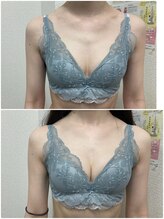 バーディー(BIRDIE)/施術1回/20代