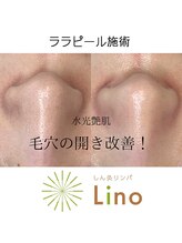 リノ(lino)/ララピールで毛穴の開きケア