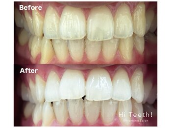 ハイティース 高田馬場店(Hi Teeth!)/医療提携セルフホワイトニング