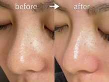 アルカンシエル(arcenciel)/毛穴改善コース