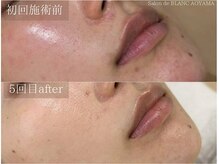 サロン ド ブラン アオヤマ(Salon de BLANC AOYAMA)/ハーブピーリング&ソノケア