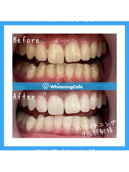 ホワイトニングカフェ 和歌山ガーデンパーク店(WhiteningCafe)/7回照射症例