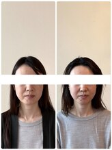 リフェイスフサエ(ReFace Fusae)/V字あご 頬の高さ　立体的なお顔