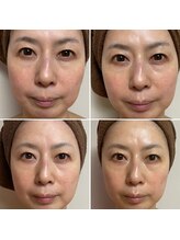 コルッソ(CoLusson.)/若肌へ！ホワイトスノーピール