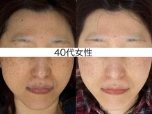 シミケア専門店 SAKURA 平塚店/30代 1回・2回・3回の写真