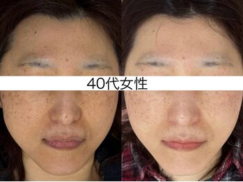 シミケア専門店 SAKURA 平塚店/30代 1回・2回・3回の写真