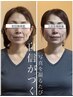 【小顔矯正】写真を撮るたびに自信がつく!あなた史上最高のフェイスラインへ