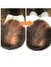 【メンズ】ヘッドスパ＋強髪110%★薄くなってきた毛を育毛促進