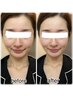 【毛穴の黒ずみ・汚れ吸引】艶々お肌が手に入る炭酸パック付き