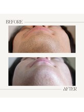 スプランドゥール(Splendeur)/メンズ【ひげ】WAX+光