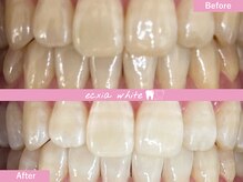エクシアホワイトニング 札幌中島公園店/Before After［ホワイトニング］