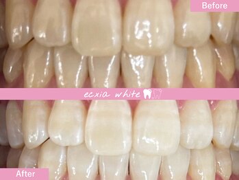 エクシアホワイトニング 札幌中島公園店/Before After［ホワイトニング］