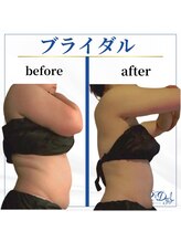 デール(R:DeeL)/ドレスのホック5個縮まったよ