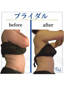 デール(R:DeeL)/ドレスのホック5個縮まったよ