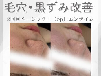 アン ネイル(ANN NAIL)/毛穴/ハーブピーリング