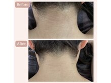 リードエピア(LEADepiA)/うなじ脱毛大人気！