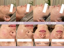 ルプレ(Lupure)の雰囲気(お肌のお悩みを徹底改善◎剥離なしハーブピーリング×植物幹細胞)