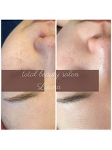 ルアナ 柏本店(LUANA)/ニキビ／毛穴／頬のシミ／改善例