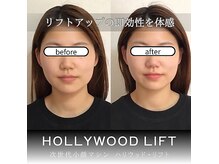 ブリリオプラス 広島並木店(Brillio Plus)の雰囲気（【ハリウッドリフト】脂肪を燃焼、筋膜からしっかりリフトアップ）