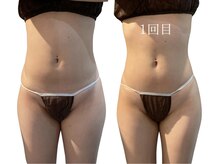 痩せラボ/一回でこんなに結果【痩身】