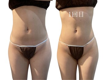 痩せラボ/一回でこんなに結果【痩身】