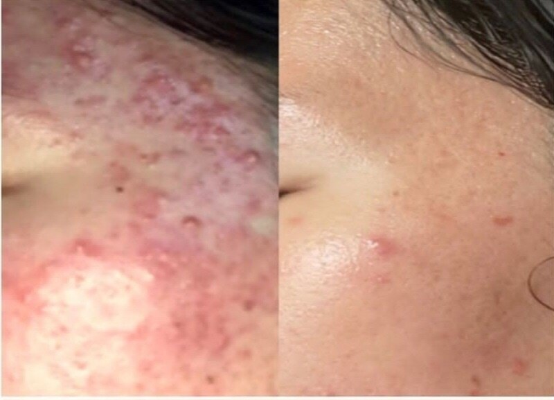 【毛穴.ニキビケア】最強9STEP(毛穴洗浄+生コラ+MC2X・銅ペプチド)120分\5500