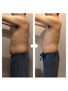 伊達男/フォースカッター事例