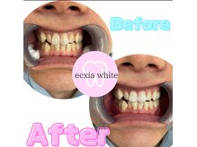 エクシアホワイトニング 可児店/ビフォーアフター
