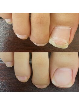 ワイヤー補正やめました