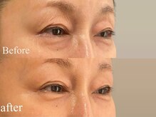 ルナステラ 金沢店/ヒト幹細胞フェイシャル