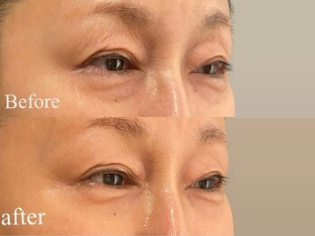 ルナステラ 金沢店/ヒト幹細胞フェイシャル