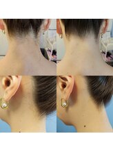 キアラ 麻布十番(Kiara)/うなじ脱毛麻布十番/毛穴/顔脱毛