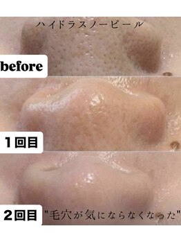 シャリオン(SHARION)の写真/韓国水光肌で毛穴悩みをケアし一度の施術でも効果を実感、つるん肌へ♪