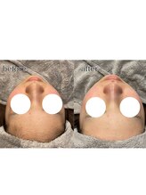 アデル 久留米(ADEL)/フェイシャルワックス