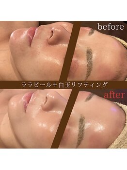 ディースズ(D.suzu)/ララピール×白玉リフトUP&鎮静