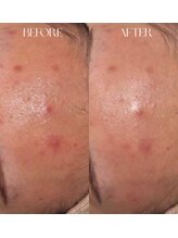 #美容革命ラボ 大阪南堀江店/毛穴洗浄・リブセラ¥梅田難波