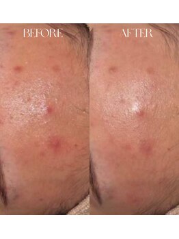 #美容革命ラボ 大阪南堀江店/毛穴洗浄・リブセラ¥梅田難波