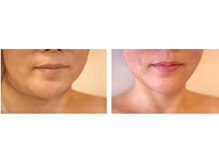 賢者のボディケア/レモンボトル小顔　