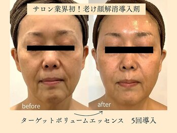 パンセリーノ(Panselinos)の写真/サロン業界初！くぼみ・頬コケ・ハリ不足…老け見えの原因にアプローチし内側から押し上がる弾力肌へ