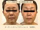 パンセリーノ(Panselinos)の写真/サロン業界初！くぼみ・頬コケ・ハリ不足…老け見えの原因にアプローチし内側から押し上がる弾力肌へ