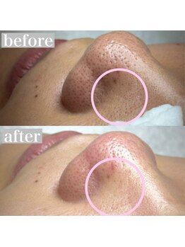 ライカブルー(RaicA BluE)/施術写真 before-after