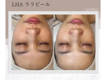 ベルーテ 田町三田(Bellute)/韓国肌管理★LHA ララピール★