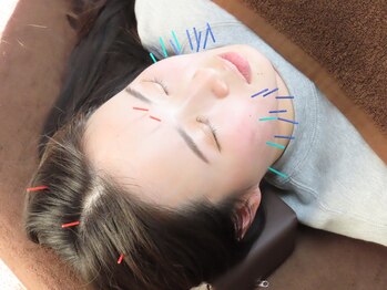 リスタート鍼灸整骨院(Ri start.鍼灸整骨院)/美容鍼