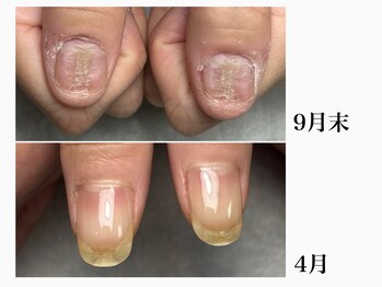 癖による凸凹爪もこんなに綺麗に